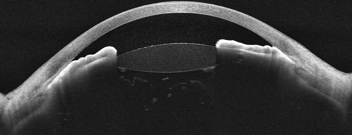 OCT du segment antérieur montrant une fermeture de l'angle avec chambre antérieure plate — glaucome malin